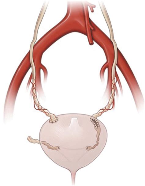 adam marcheluk|Reconstructive surgery of the extensive ureter strictures using。